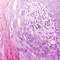 Cancer staging plays a pivotal role in the battle on cancer
