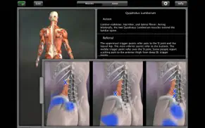 muscle trigger point anatomy iphone capturas de pantalla 3