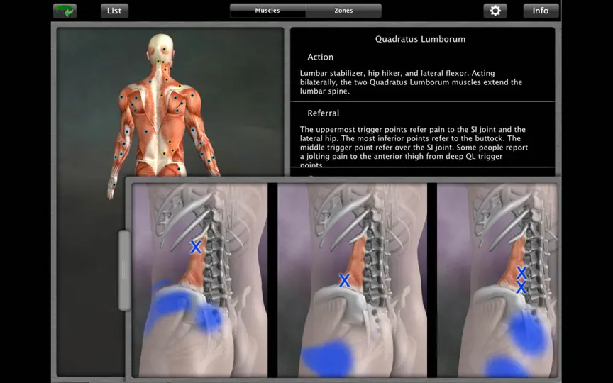 Muscle Trigger Point Anatomy iPhone Screenshot 3