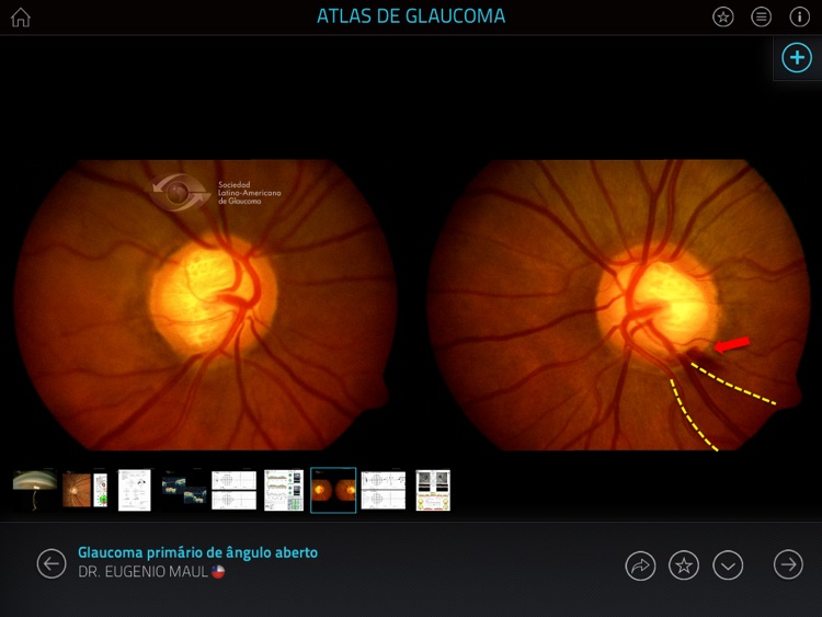 Atlas de Glaucoma screenshot-4