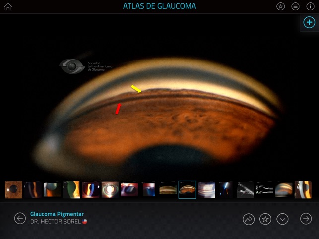 Atlas de Glaucoma(圖3)-速報App