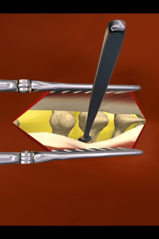 mLumbarLaminectomy screenshot 2