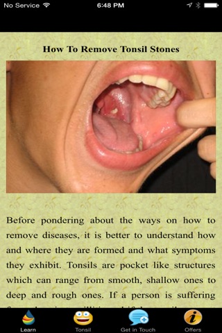 How To Remove Tonsil Stones screenshot 2