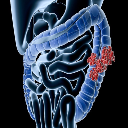 Colo-Rectal Cancer Screening