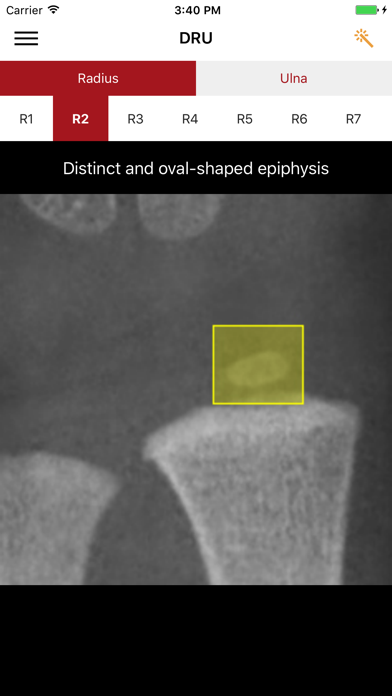 How to cancel & delete DRU - Distal Radius & Ulna Classification from iphone & ipad 4