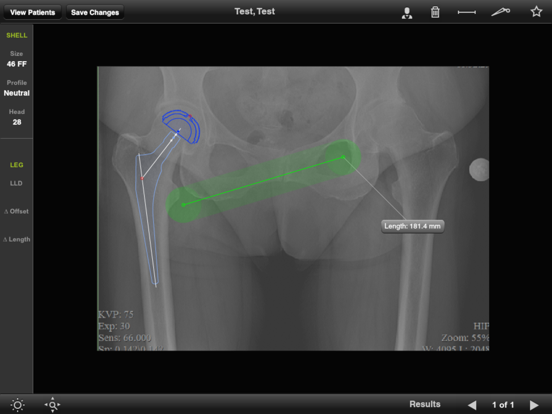 Screenshot #4 pour Biomet Orthosize Templating