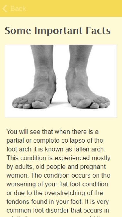 Symptoms Of Fallen Arches