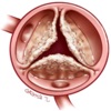 Apraise Aortic Stenosis