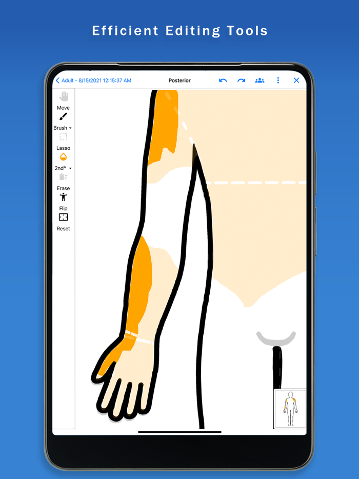Surface Burn Calculator