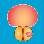 Download Nyushko prostate nomograms app
