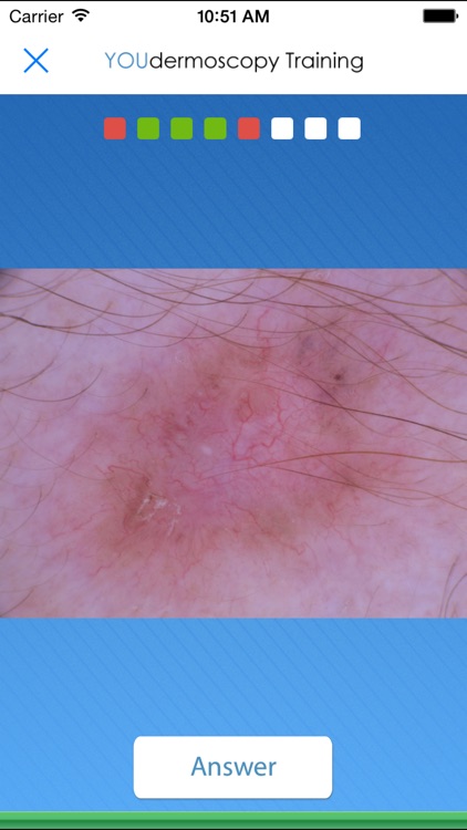 YOUdermoscopy screenshot-3