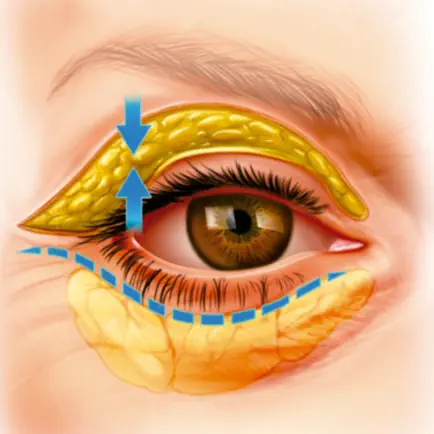 IPO Blefaroplastia RA Cheats