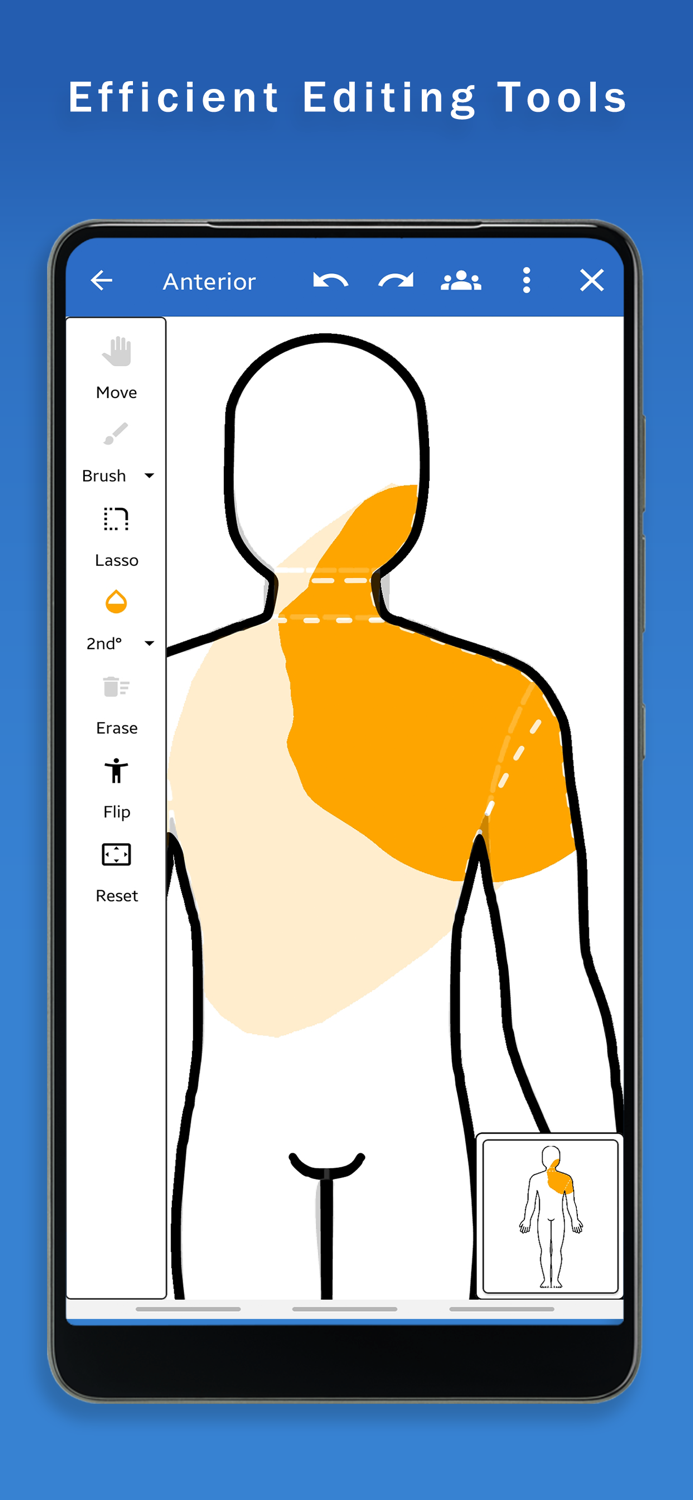 Surface Burn Calculator