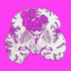 Neuro-oncology: WTD icon