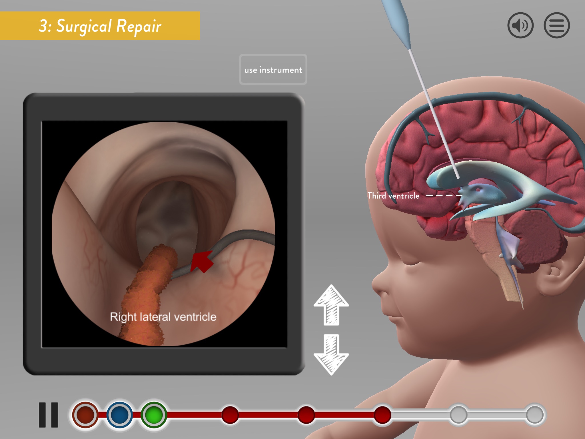 Hydrocephalus Procedure screenshot 3