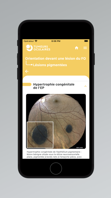 Tumeurs Oculaires Screenshot