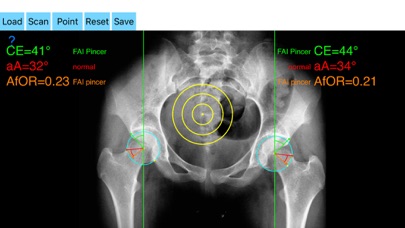 FemoroAcetabularImpingementApp screenshot 4