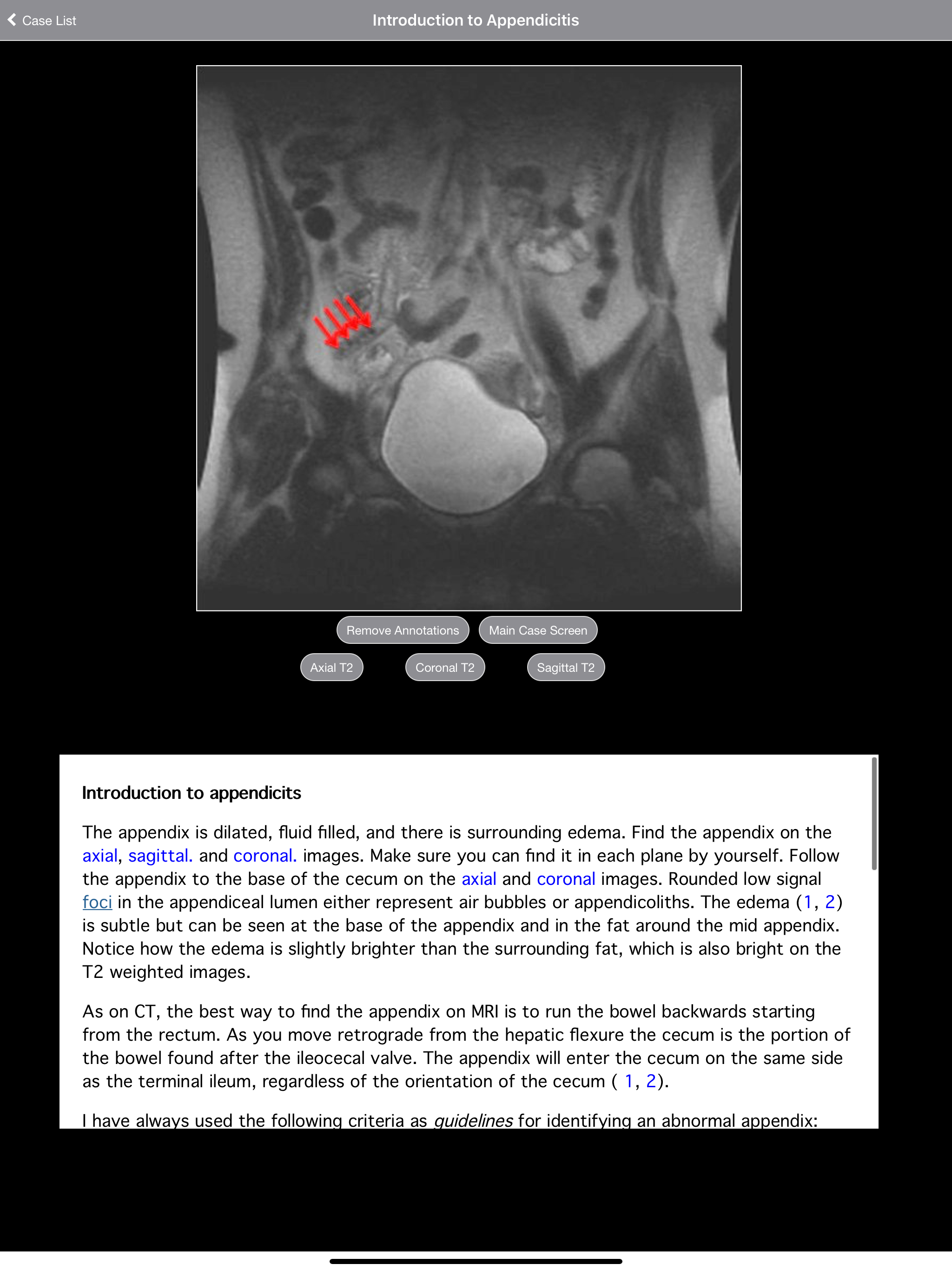 Pregnant Appendicitis screenshot 3