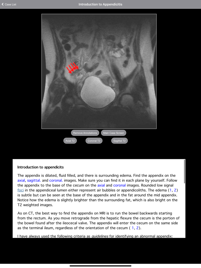 Pregnant Appendicitis