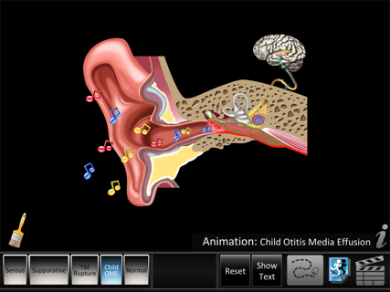 Otitis Media Disorders screenshot 8