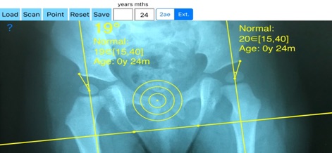 CenterEdgeAngleApp - Medical App | MWM