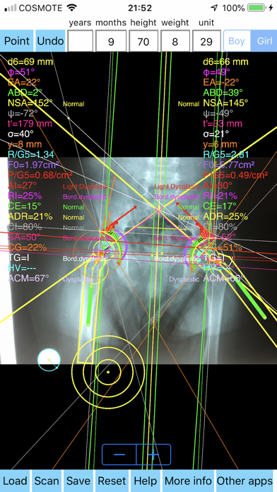 Screenshot #1 pour PapadimitriouAbductionSplint