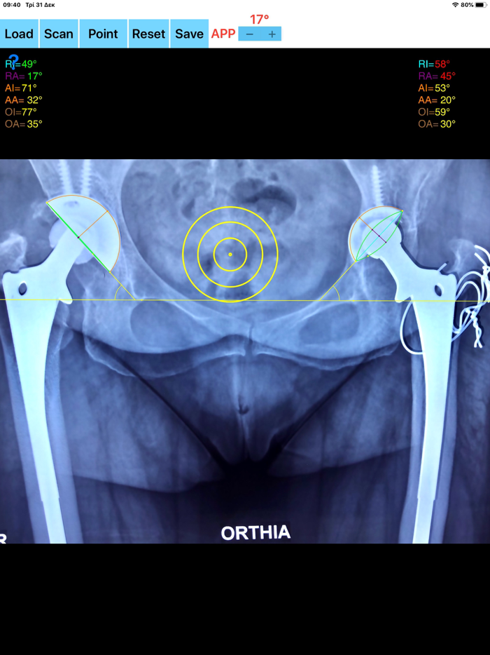 CupAnteversionInclinationApp