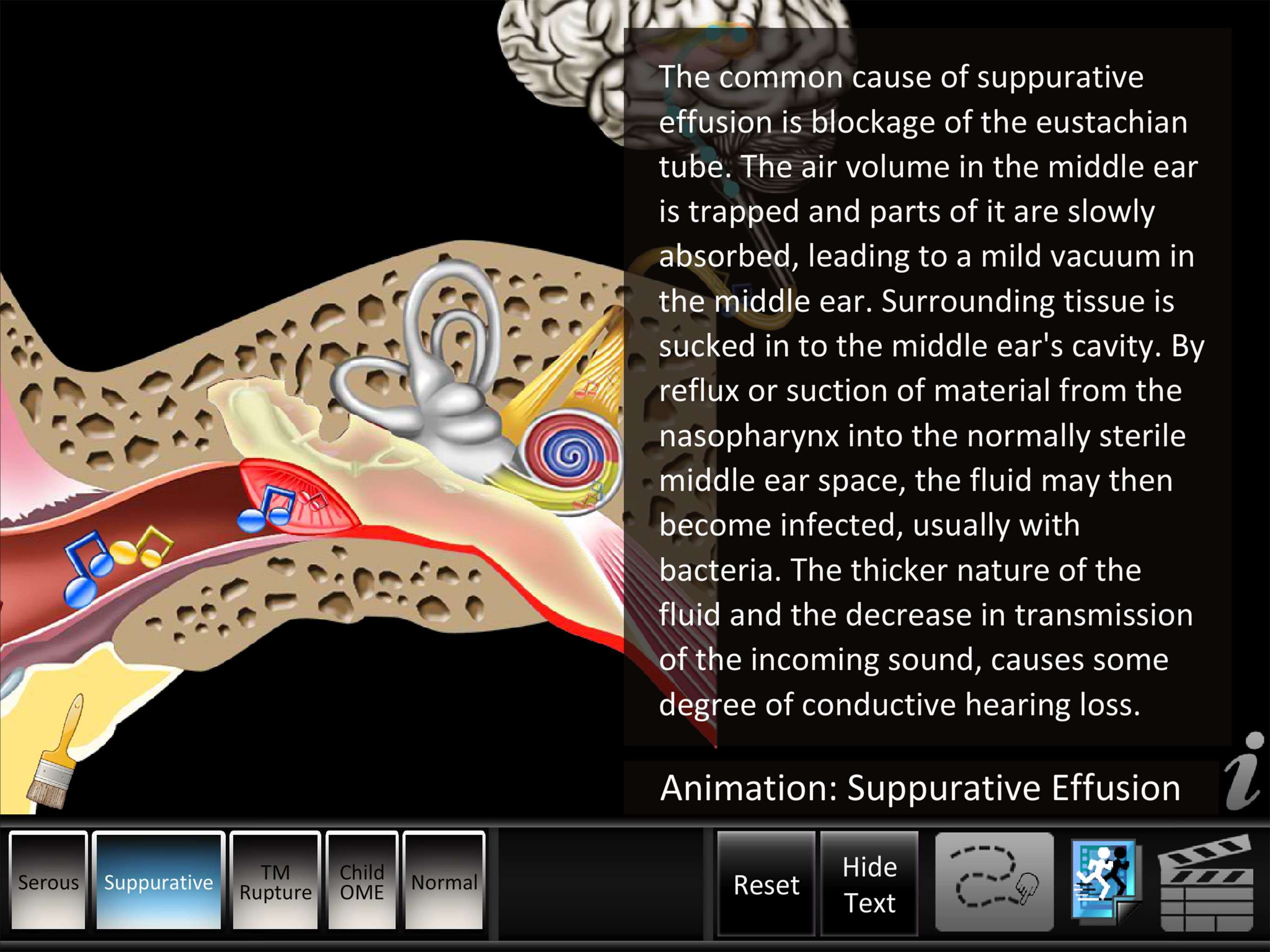 Otitis Media Disorders screenshot 7