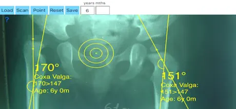 NeckShaftAngle App