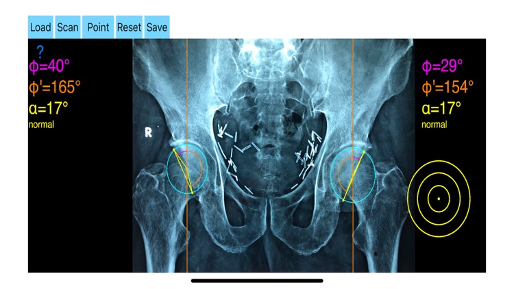 AcetabularAnteversionApp screenshot-5