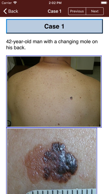 Dermoscopy Two Step Algorithm screenshot-4