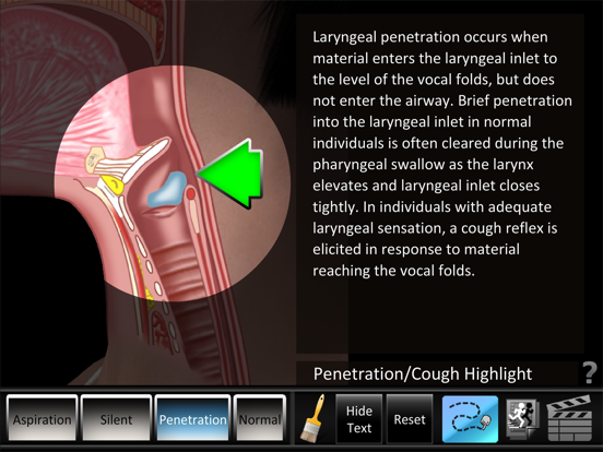 Screenshot #5 pour Aspiration Disorders