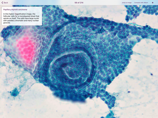 Screenshot #6 pour Thyroid Pathology