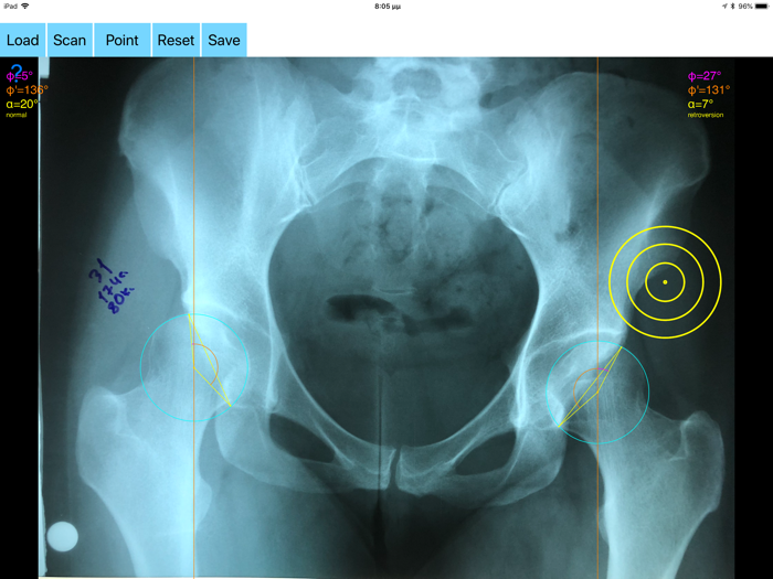 AcetabularAnteversionApp