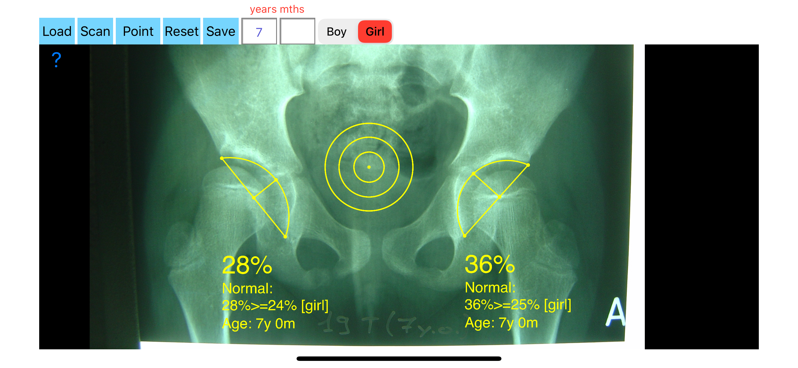 AcetabularDepthRatioApp screenshot 7