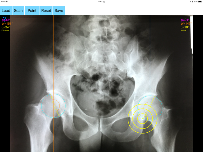 AcetabularAnteversionApp