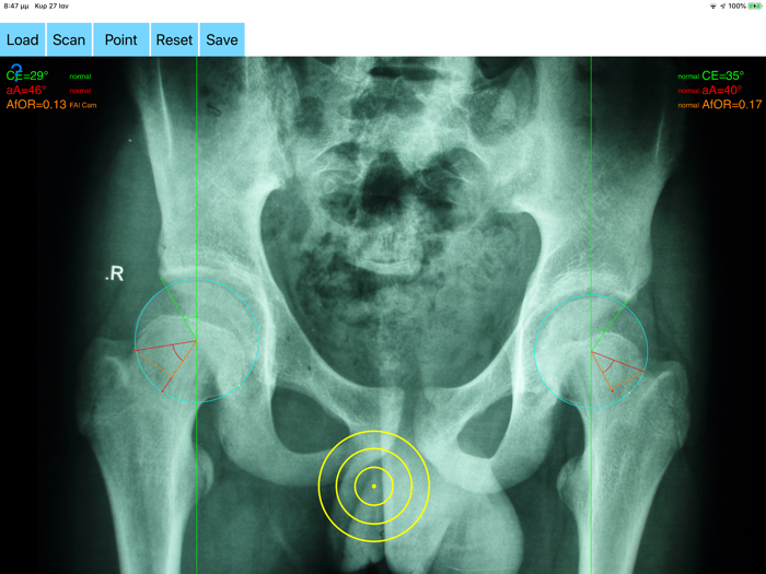 FemoroAcetabularImpingementApp