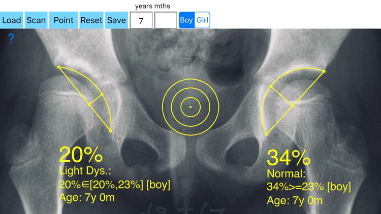 AcetabularDepthRatioApp screenshot-4