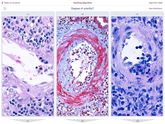 Renal Transplant Pathologyのおすすめ画像7