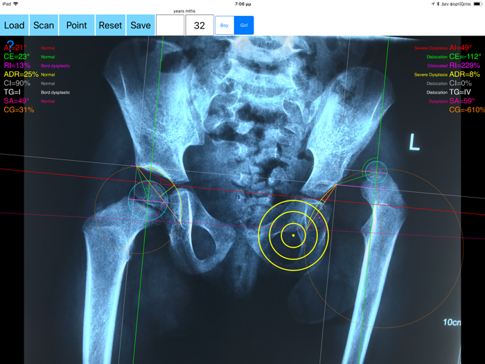 HipDysplasiaApp