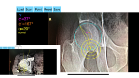 AcetabularAnteversionApp screenshot