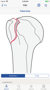 AO/OTA Fracture Classification screenshot