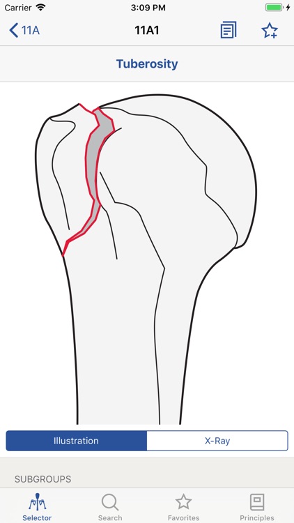AO/OTA Fracture Classification screenshot-3