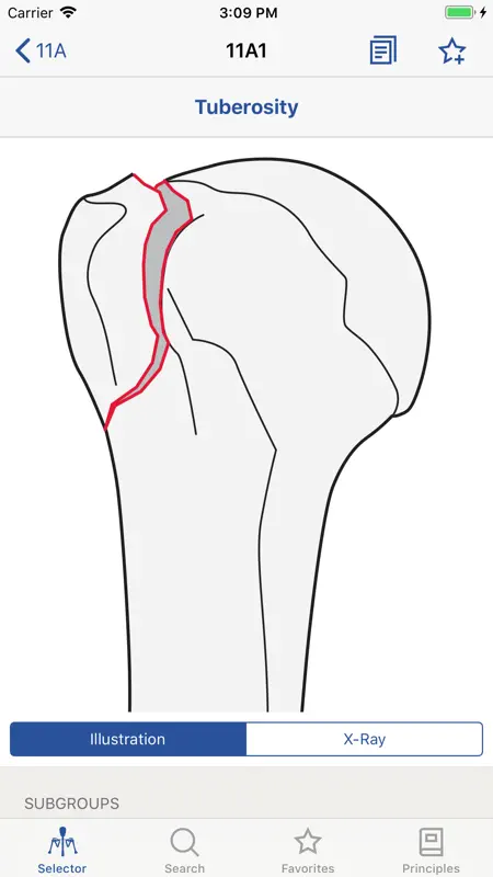 AO/OTA Fracture Classification screenshot 4 of 5