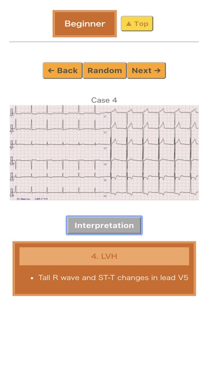 Pocket ECG