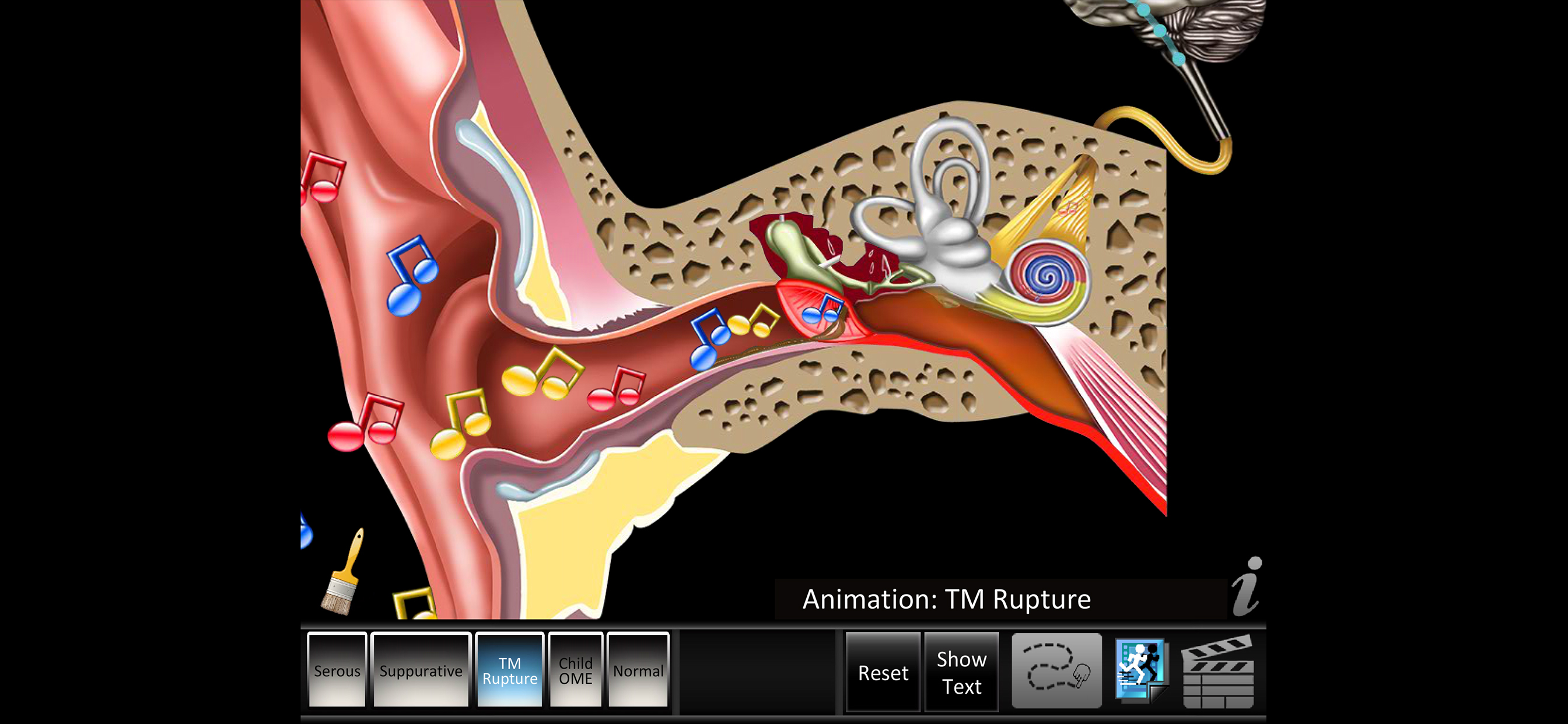 Otitis Media Disorders screenshot 4