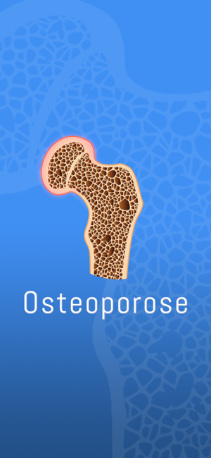 Osteoporose(圖1)-速報App