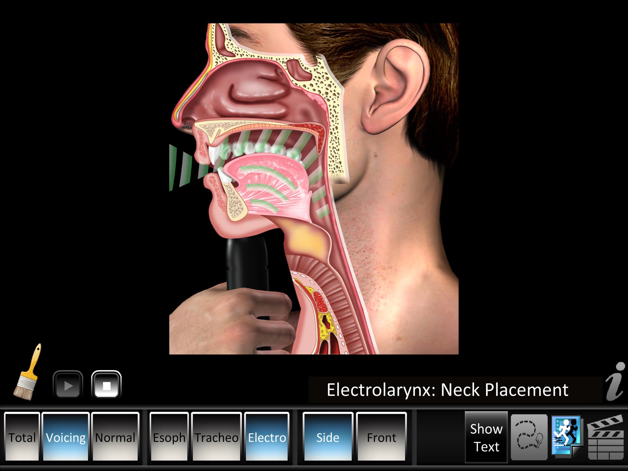 Laryngectomy screenshot 3