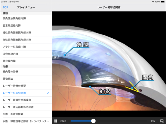 iCeye 緑内障のおすすめ画像2