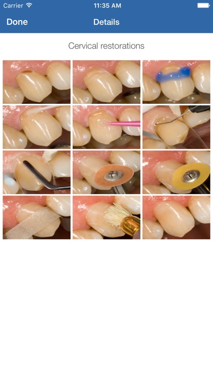 Dental Composite